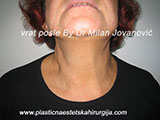 Neck after face lift