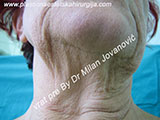 Neck before face lift