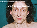 Result before facial fat grafting Result before facial fat grafting