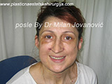 Result after facial fat grafting Result after facial fat grafting