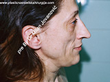 Result before facial fat grafting Result before facial fat grafting