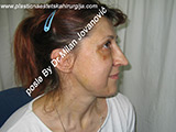 Result after facial fat grafting Result after facial fat grafting
