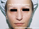 Result before facial fat grafting Result before facial fat grafting
