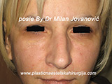 Result after facial fat grafting Result after facial fat grafting