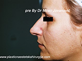 Result before facial fat grafting Result before facial fat grafting
