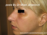 Result after facial fat grafting Result after facial fat grafting