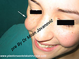 Result before facial fat grafting Result before facial fat grafting