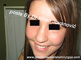 Result after facial fat grafting Result after facial fat grafting