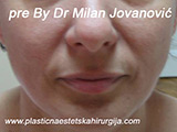 Before Face fillers Before Face fillers