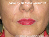 After Face fillers After Face fillers