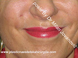 After Face fillers After Face fillers