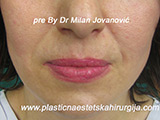Before Face fillers Before Face fillers