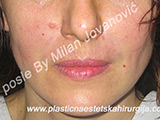 After Face fillers After Face fillers