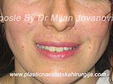 After Face fillers After Face fillers