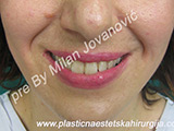 Before Face fillers Before Face fillers