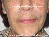 After Face fillers After Face fillers