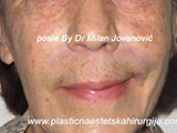 After Face fillers After Face fillers