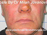 After Face fillers After Face fillers