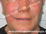 After Face fillers After Face fillers