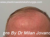 Before hair transplantation