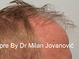 Before hair transplantation