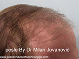 Results after one year after hair transplantation