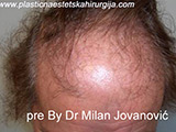 Before hair transplantation