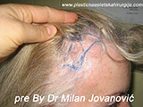 Before hair transplantation