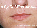 Before lip augmentation Before lip augmentation