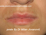 After lip augmentation After lip augmentation