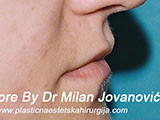 Before lip augmentation Before lip augmentation