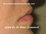 After lip augmentation After lip augmentation