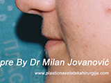 Before lip augmentation Before lip augmentation