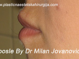 After lip augmentation After lip augmentation