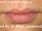 Before lip augmentation Before lip augmentation