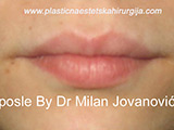 After lip augmentation After lip augmentation