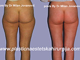 Result before and after liposuction Result before and after liposuction