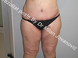 Result after liposuction Result after liposuction