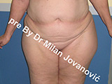 Result before liposuction Result before liposuction