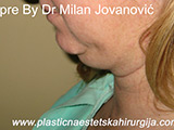 Result before liposuction Result before liposuction