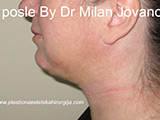 Result after liposuction Result after liposuction