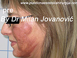 Two days after microdermabrasion Two days after microdermabrasion
