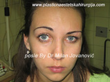 After scar removal After scar removal