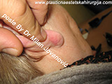 After scar removal After scar removal