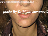 After scar removal After scar removal