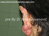 Before scar removal Before scar removal