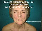 Before the plastic surgery Before the plastic surgery