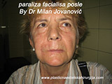 After the plastic surgery After the plastic surgery