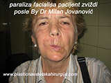 After the plastic surgery After the plastic surgery
