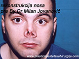 Before the plastic surgery Before the plastic surgery